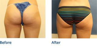 SmartLipo Austin Before & After Photos
