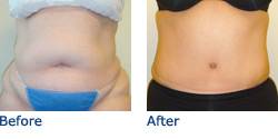 Tummy Tuck Before & After Photos