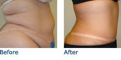 Tummy Tuck Before & After Photos
