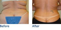Tummy Tuck Before & After Photos