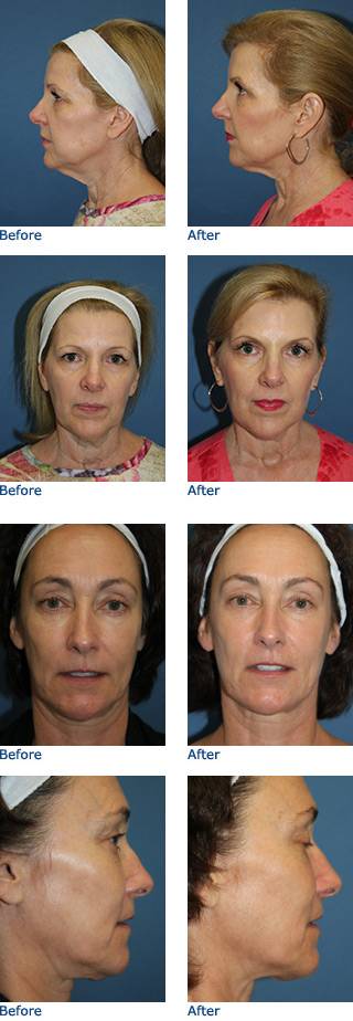 Ultherapy® Austin Texas Before & After Photos