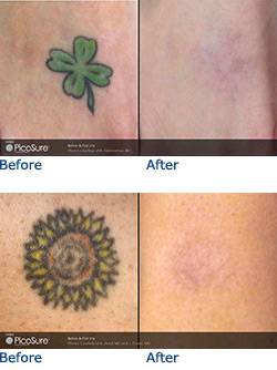 Austin Tattoo Removal - PicoSure Laser Tattoo Removal