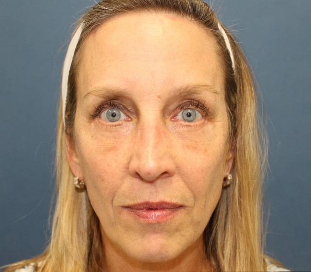 brow lift surgery in austin free consultation