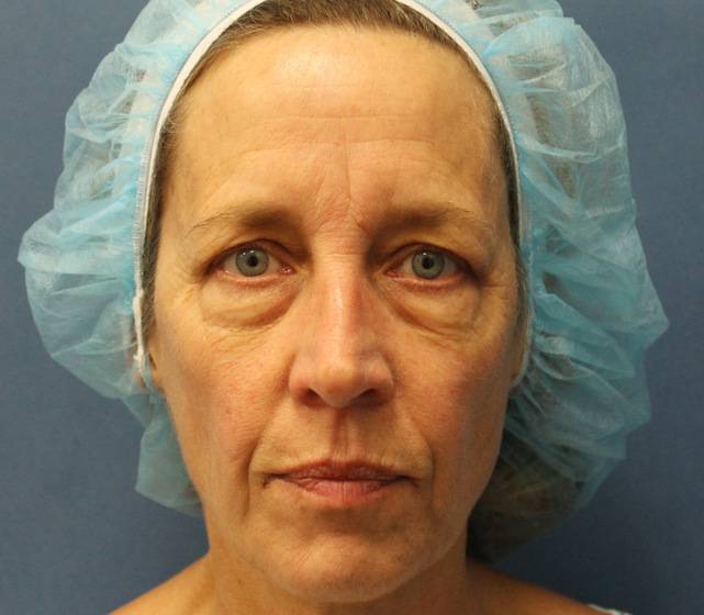 brow lift surgery in austin free consultation