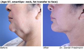 Patient O SmartLipo side view Before and After