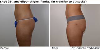 Patient D liposuction up view Before and After