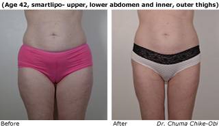 Patient B liposuction Before and After