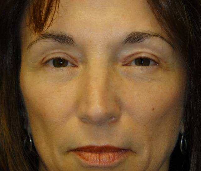 Patient 10020 brow lift after