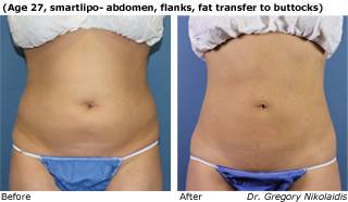 Patient C SmartLipo side view Before and After