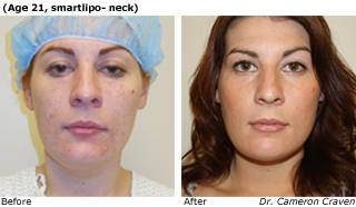 Patient J liposuction side view Before and After