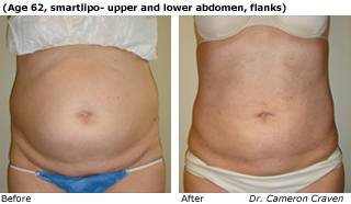 Patient C liposuction side view Before and After