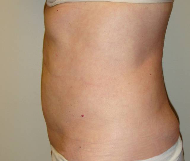 patient A Liposuction after side view