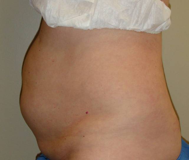 patient A Liposuction before side view
