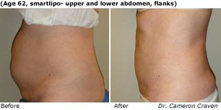 Patient C liposuction Before and After