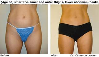 Patient C SmartLipo Before and After