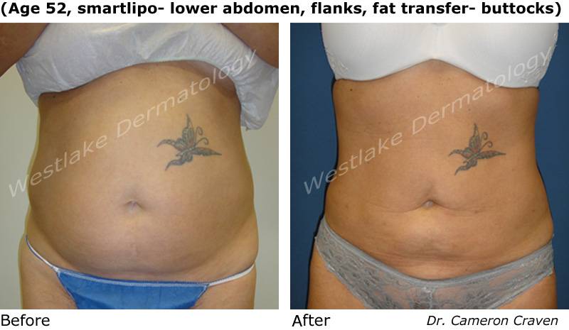 Smartlipo Flanks Liposuction for Women - Before & After Photos