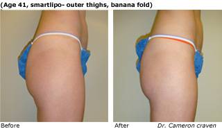 Patient N liposuction Before and After