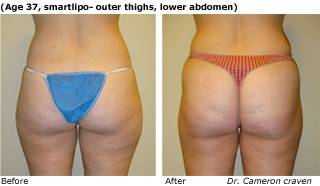 Patient R liposuction side view Before and After