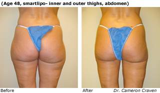 Patient A SmartLipo side view Before and After