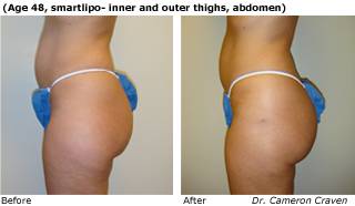 Patient A SmartLipo up view Before and After