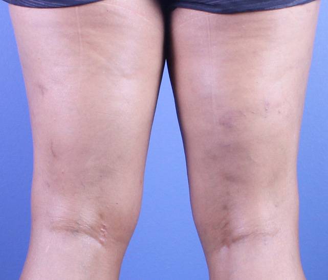 patient A sclerotherapy after