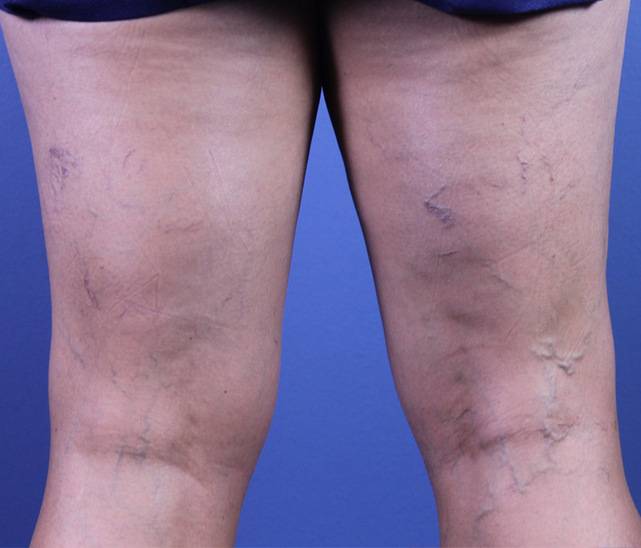 patient A sclerotherapy before