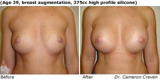 patient A breast augmentation front