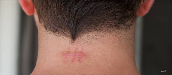 scar removal