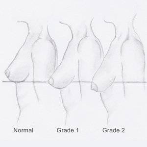 breast lift chart