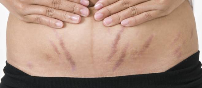 Stretch Mark Removal: What Really Works?- Get Rid of Stretch Marks