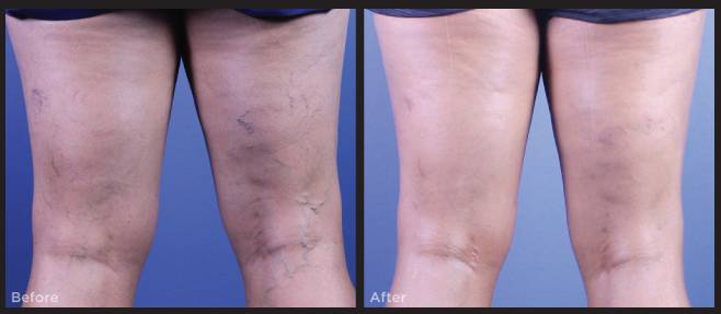 sclerotherapy case study