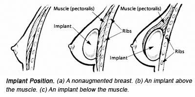 Breast Implant Placement: Over The Muscle vs. Under The Muscle