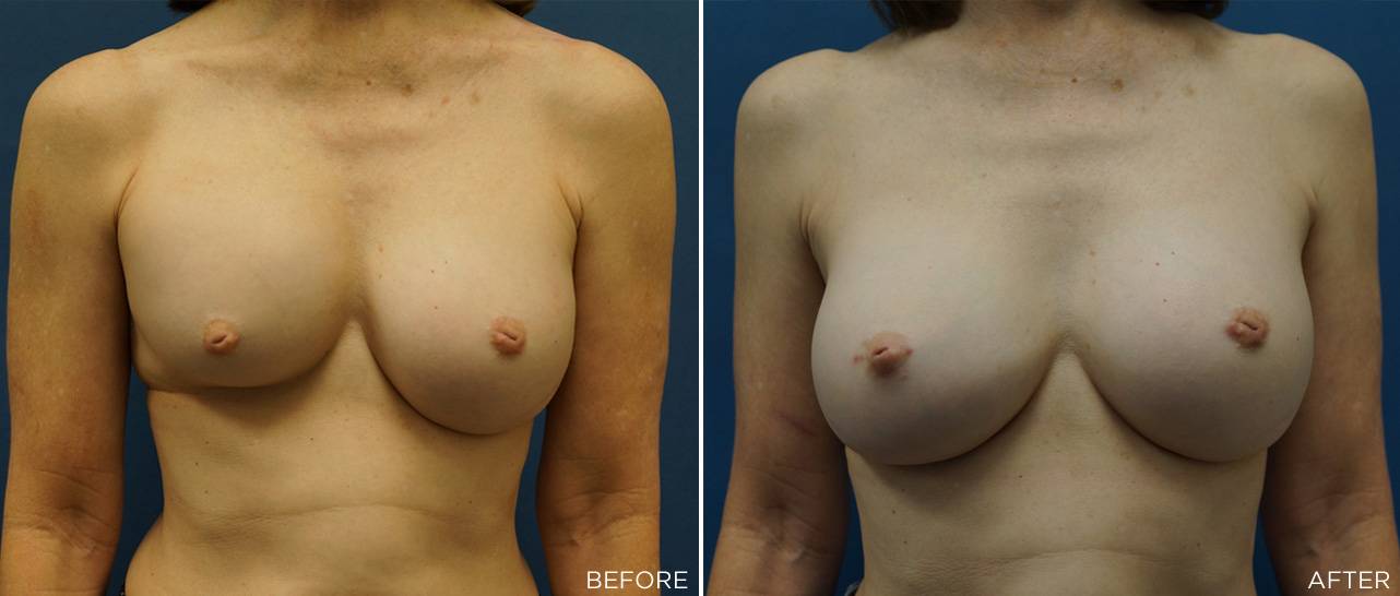 Patient C - Breast Implant Revision