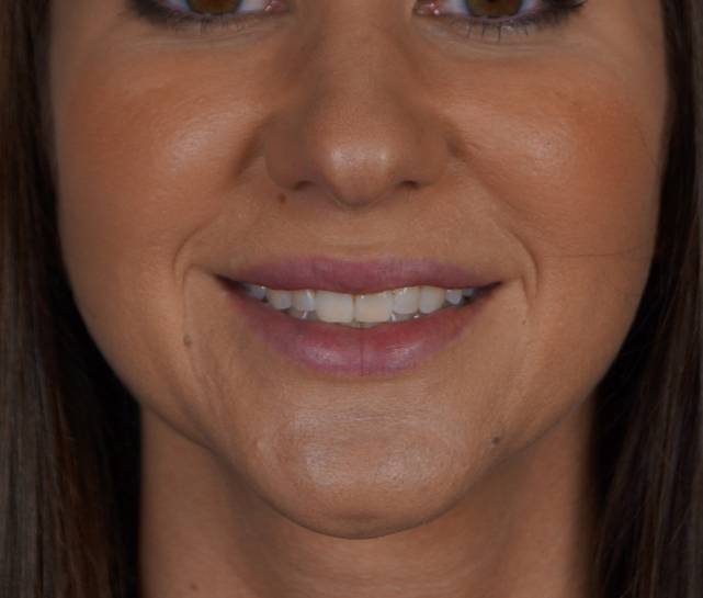 Juvederm mouth view after