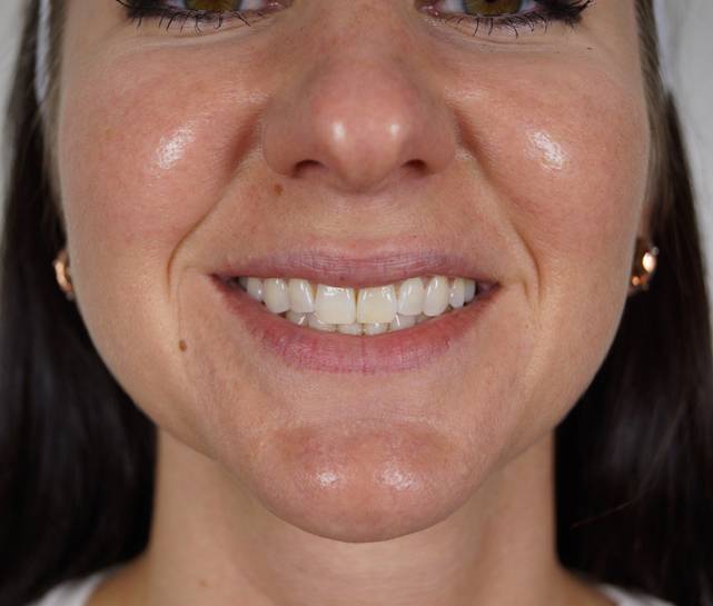 Juvederm mouth view before