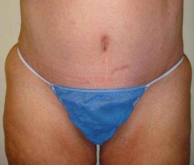 after tummy tuck front