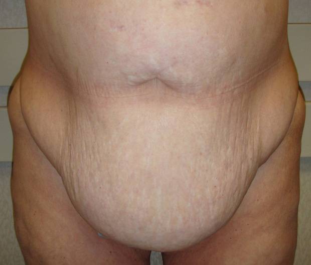 before tummy tuck front