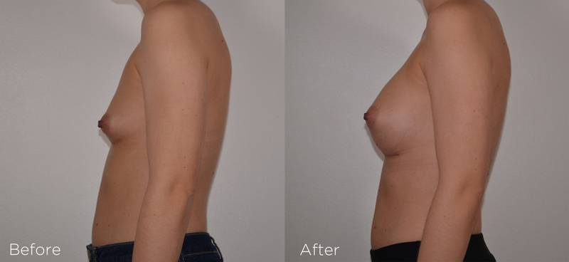 breast implant before and after