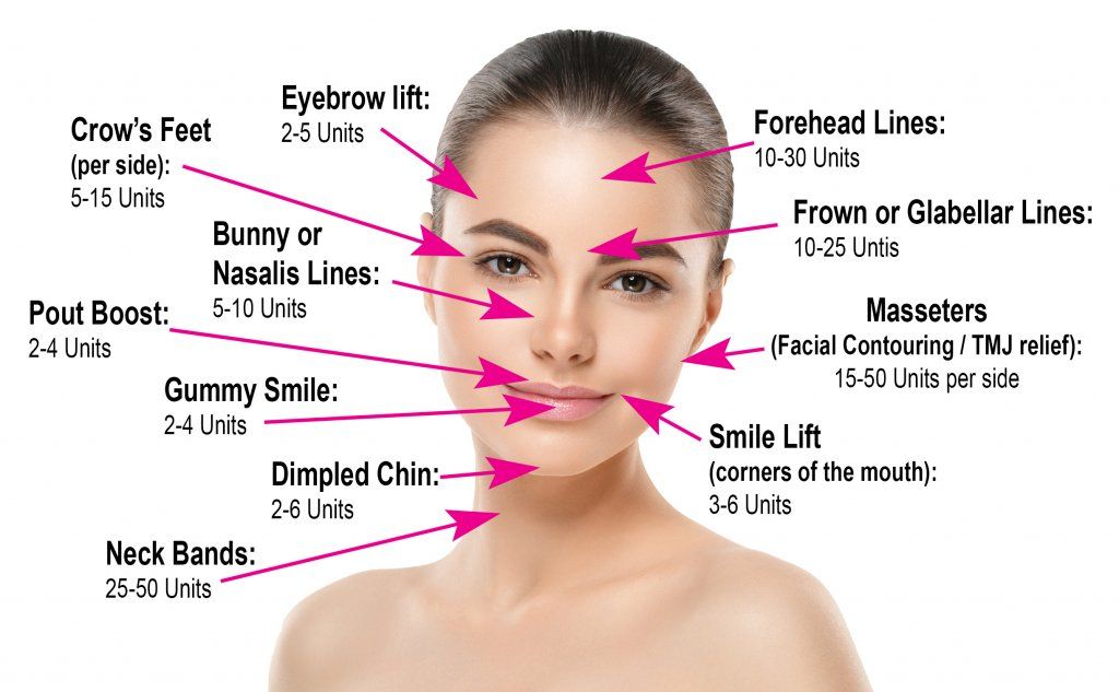 chart botox units per facial area