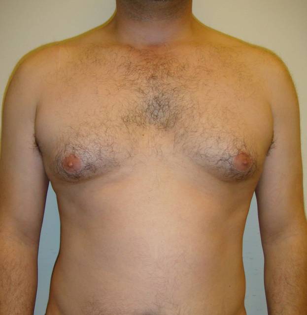 Flat Chest Puffy Nipples