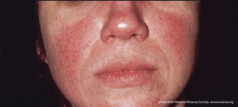 botox for rosacea