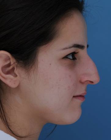 patient 100194 rhinoplasty side view before