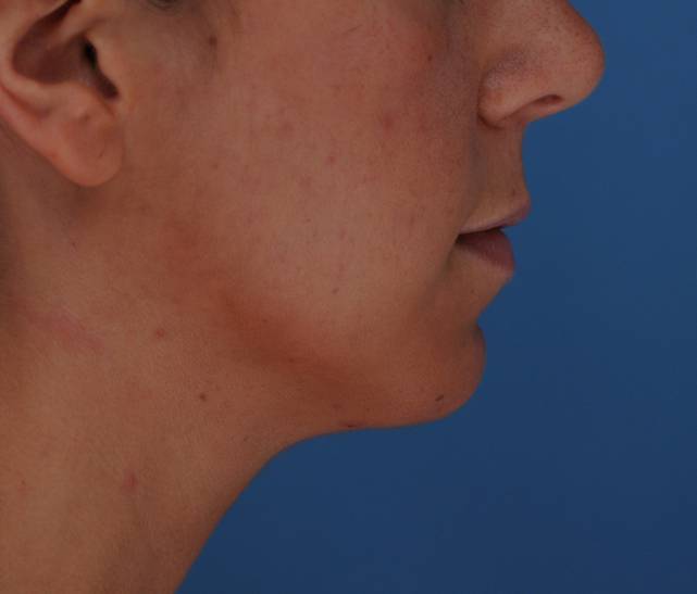 chin augmentation side after
