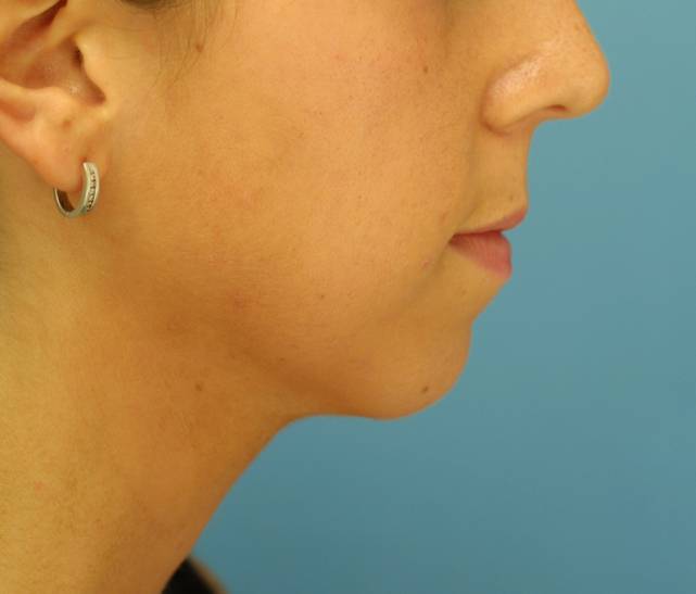 chin augmentation side before