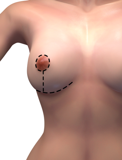 breast augmentation and lift scares Breast augmentation and lift scares