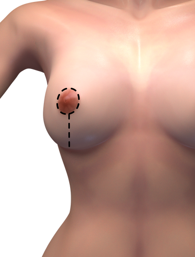 vertical breast lift