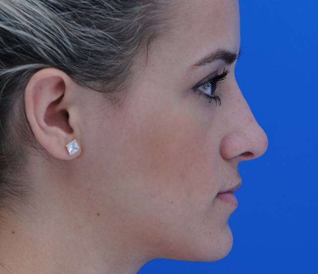 Liquid Rhinoplasty Side After