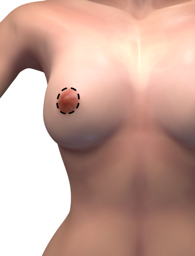 circumareolar breast lift