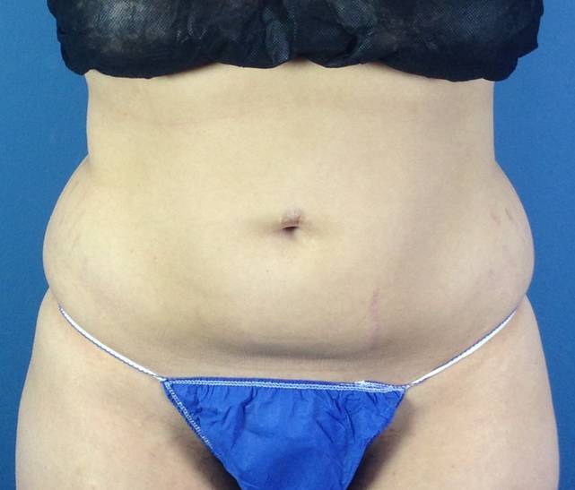 front smartlipo before