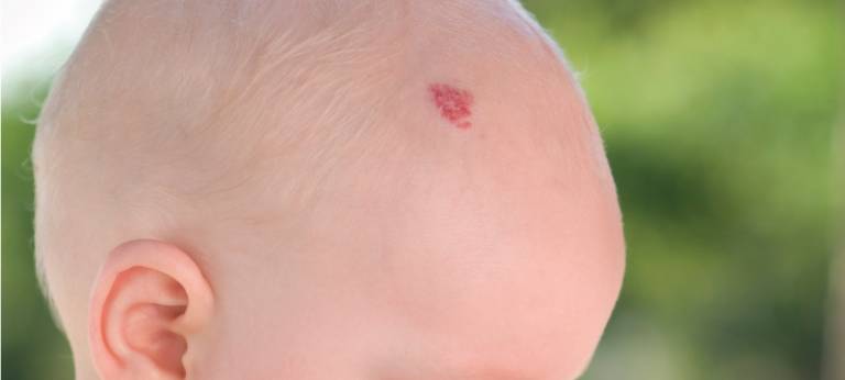 Birthmark Removal And Treatment Options